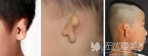 小耳畸形的患者严重程度