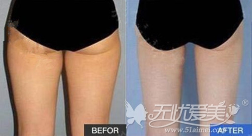 郑州集美大腿吸脂手术案例