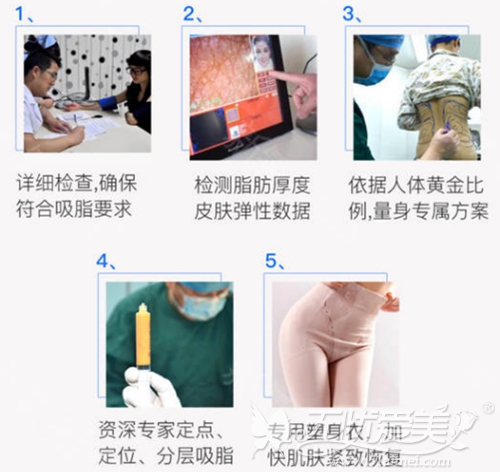 郑州集美360°分层吸脂手术过程