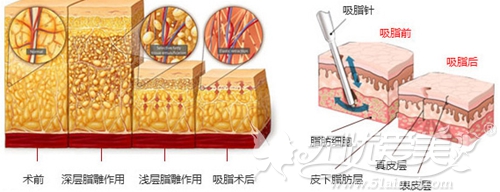郑州集美360°分层吸脂手术原理