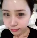 22岁的她在南京韩辰花费5千多注射玻尿酸找回青春 重拾自信
