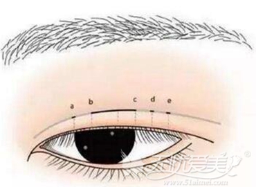 亳州韩式三点双眼皮