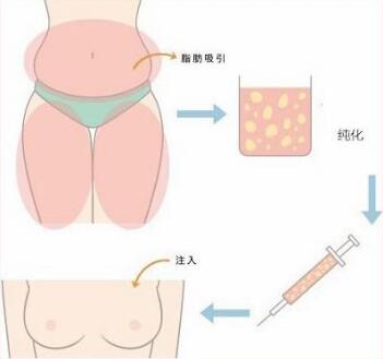 韩国首延自体脂肪隆胸手术