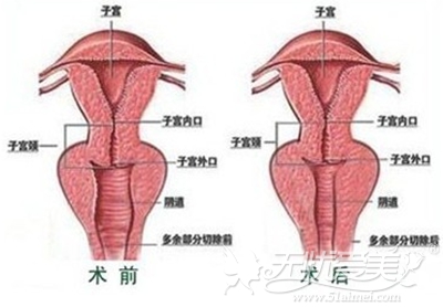 广州华美阴道缩紧术17900元还你紧致