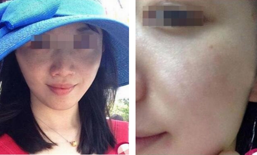 北京新面孔激光祛斑案例