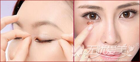 长沙亚太整形韩式双眼皮手术