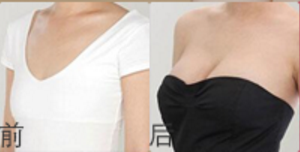 长沙瑞美无痕微创3D美胸术案例