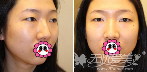 我在韩国艾恩做眼鼻综合+自体脂肪填充术前