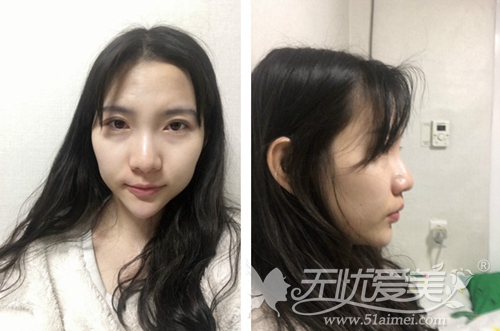 我在韩国宝士丽做隆鼻手术前照片