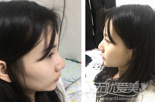 我在韩国宝士丽做隆鼻手术当天