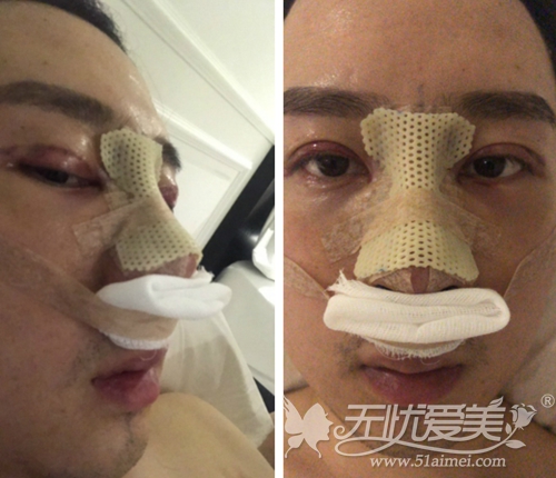 我在韩国宝士丽做眼鼻整形+面部手术当天