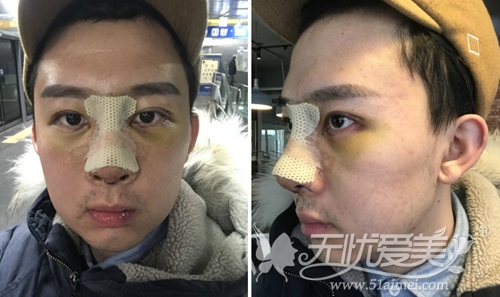 我在韩国宝士丽做眼鼻整形+面部手术后2天