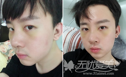 我在韩国宝士丽做眼鼻整形+面部手术后3天