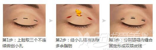 美联致美韩式双眼皮手术