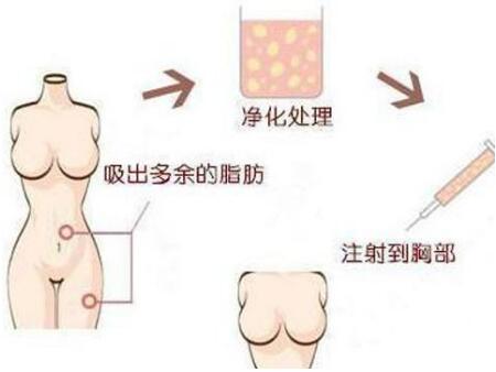 韩国IRIS整形自体脂肪丰胸手术