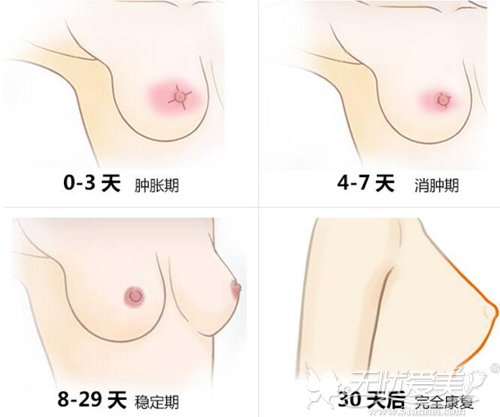 乳房矫正术恢复过程