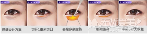 北京新星靓细致外切法祛眼袋