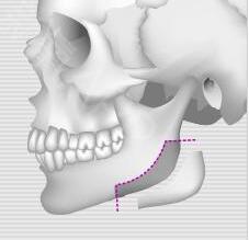 韩国布拉德皮质截骨下颌角手术