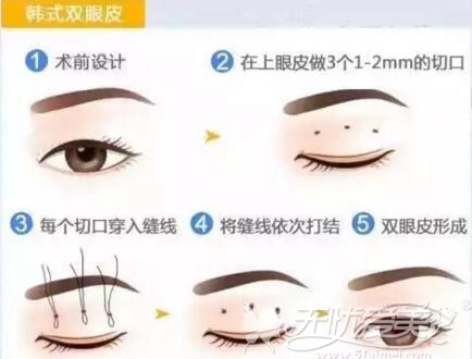 襄阳韩式双眼皮手术