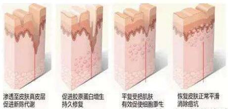 北京善方医院皮肤科激光祛痘过程
