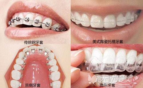 不同的牙齿矫正方法