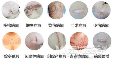 重庆骑士CR无痛介入祛疤细胞活化术可以改善疤痕类型