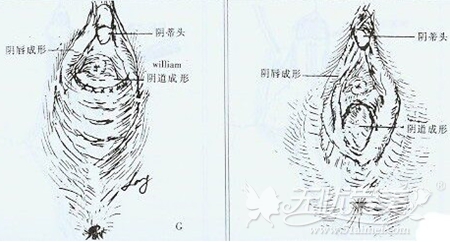 福州华美阴蒂整形手术