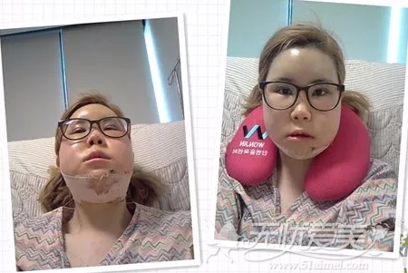 我在韩国原辰做面部轮廓手术+眼部整形术后1周恢复