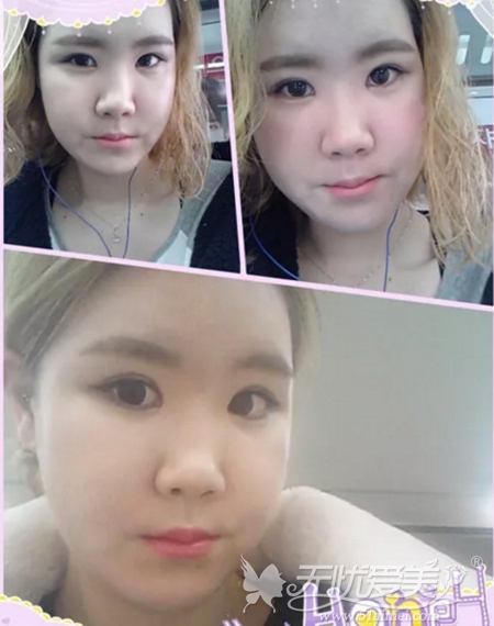 我在韩国原辰做面部轮廓手术+眼部整形术后4周