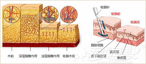 保定蓝山韩式吸脂