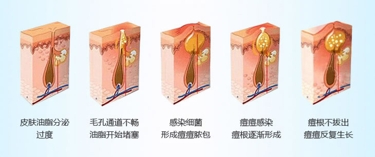 武汉亚太整形激光祛痘