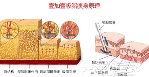 广州壹加壹分层吸脂手术原理