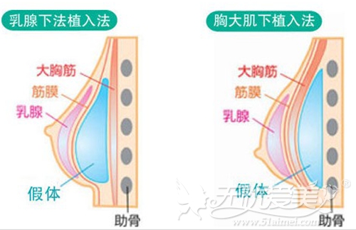 合肥壹加壹隆胸手术