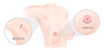 韩国EVE整形假体隆胸手术切口