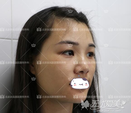 北京京民整形做的鼻综合+面部吸脂+面部填充整形术前