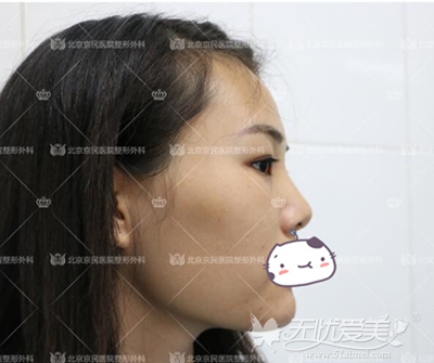 北京京民整形做的鼻综合+面部吸脂+面部填充整形术前