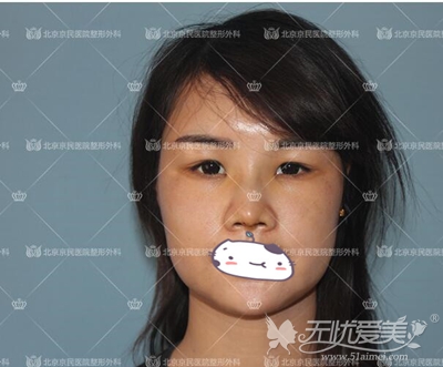 北京京民整形做的鼻综合+面部吸脂+面部填充整形术后5天