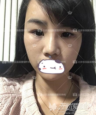 北京京民整形做的鼻综合+面部吸脂+面部填充整形术案例