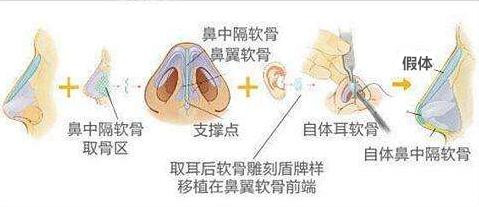 长沙至雅鼻综合手术