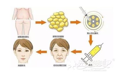 杭州华山连天美脂肪填充手术整形过程