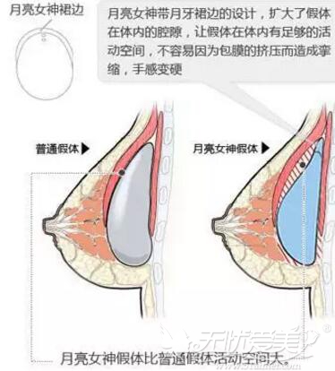 月亮女神隆胸假体预防包膜挛缩