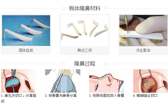 益阳南湖假体隆鼻手术材料及过程