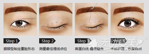 广州远东埋线双眼皮手术整形