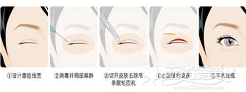 广州远东切开法双眼皮手术整形