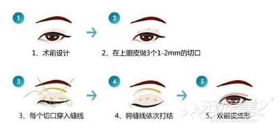 上海欧莱美整形韩式双眼皮手术
