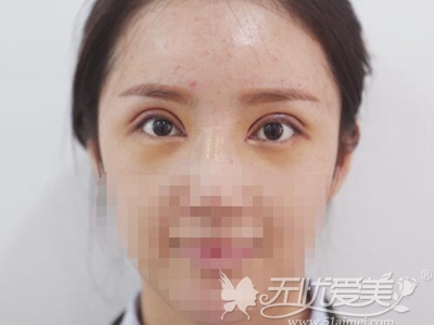 眼部医生刘晓吉双眼皮手术案例