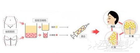 六盘水吴氏嘉美自体脂肪隆鼻手术