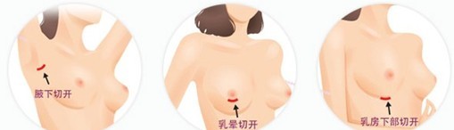 韩国普罗普姿假体隆胸手术