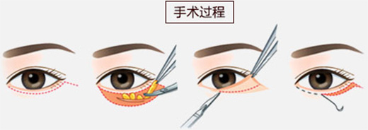 哈尔滨瑞格韩式祛眼袋手术