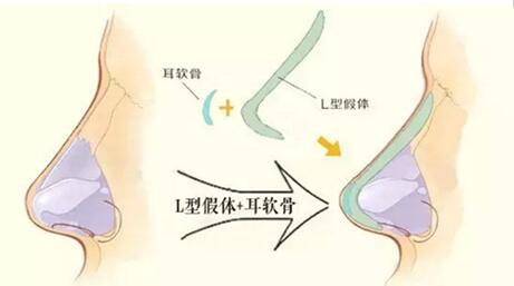 韩国Dr.朵鼻综合手术